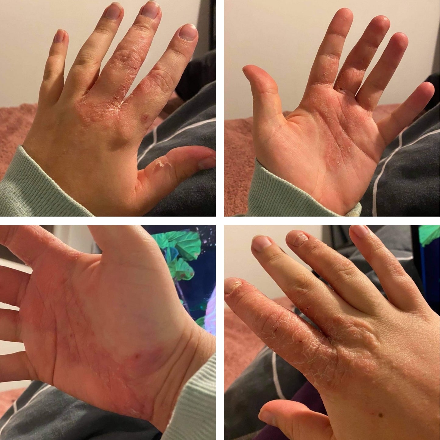 Freeskin Eczema Cream: Hands Before and After